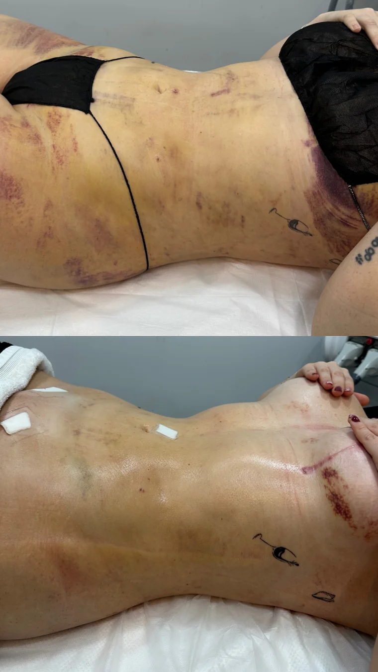 Antes y después de un tratamiento postquirúrgico
